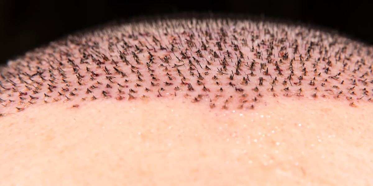 Follicular Unit Transplantation